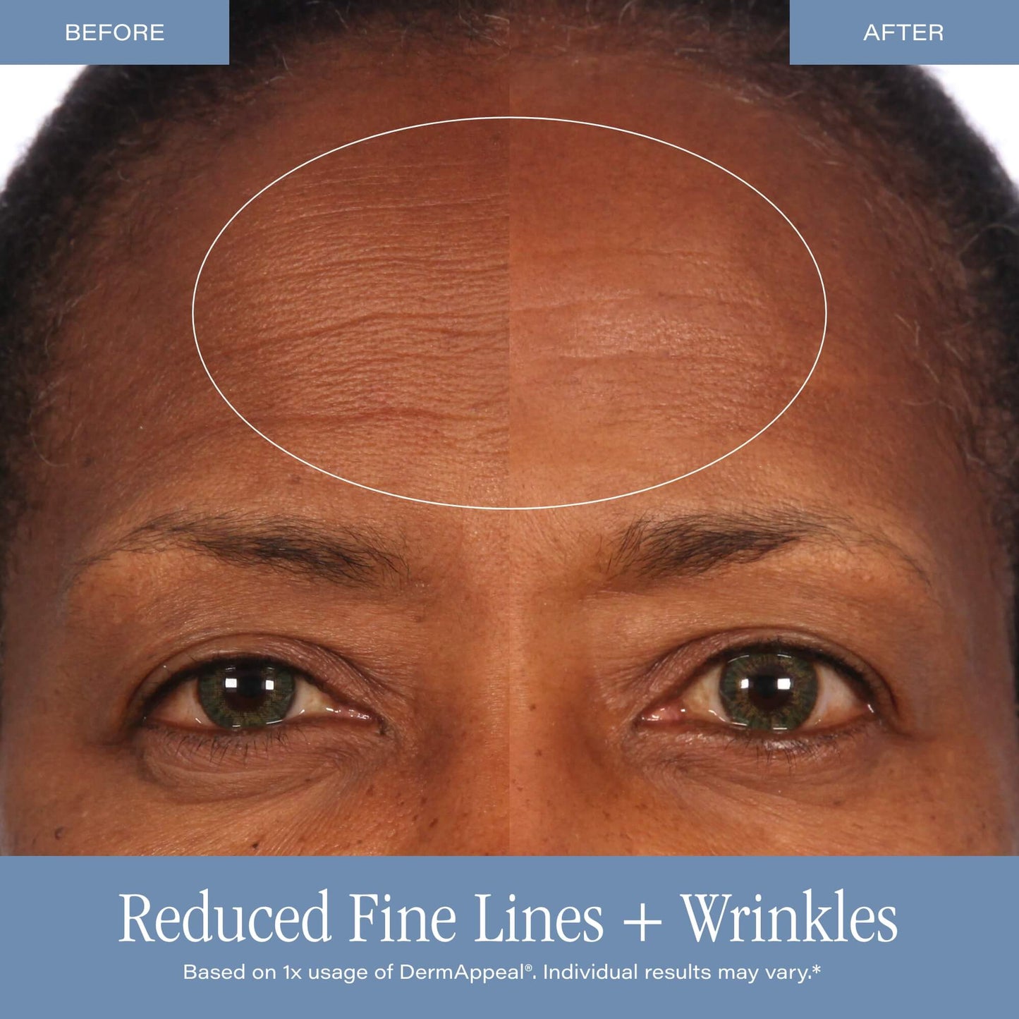 DermAppeal® Microdermabrasion Treatment-Shop