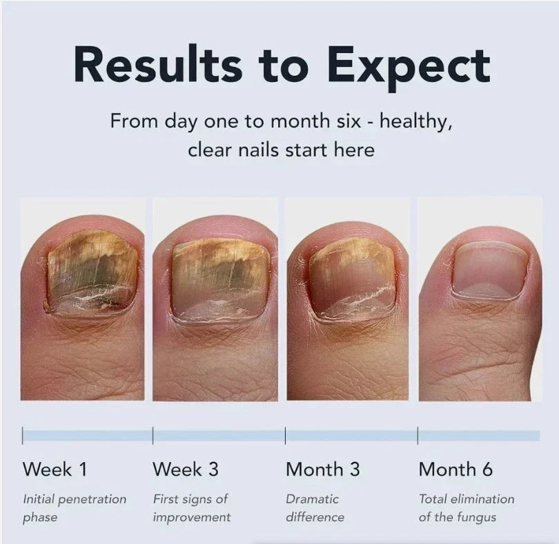 Lunavia Antifungal Pen: 25% Undecylenic Acid Toenail Fungus Treatment